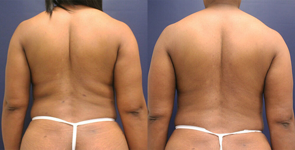 Back / Bra Bulges Before and After Photo by Rejuvalife Vitality Institute in Beverly Hills