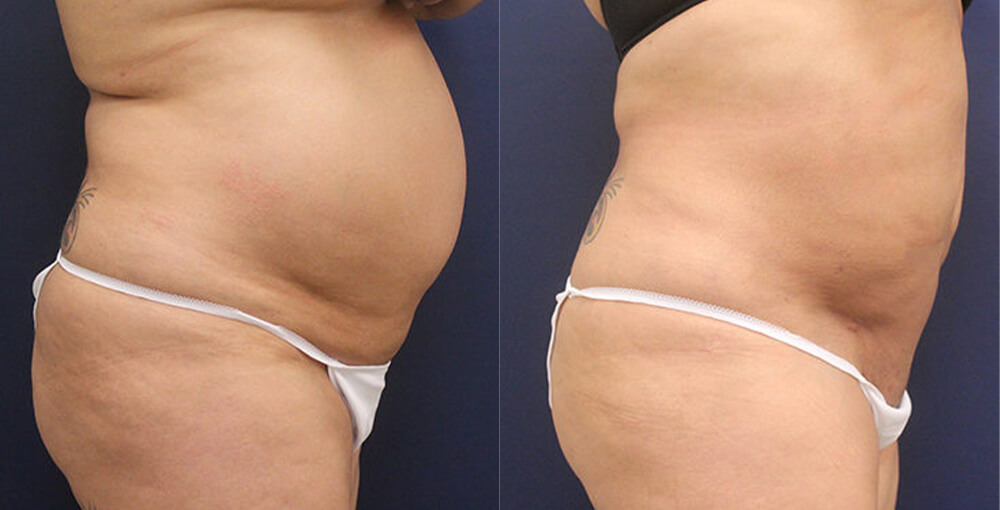 Abdomen / Flanks Before and After Photo by Rejuvalife Vitality Institute in Beverly Hills