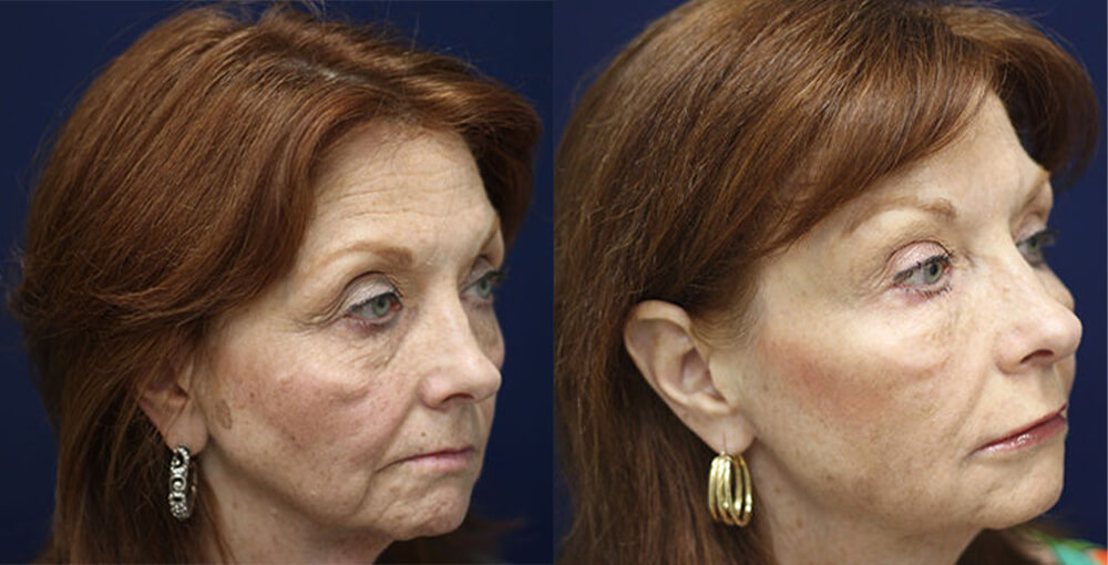 Botox Before and After Photo by Rejuvalife Vitality Institute in Los Angeles
