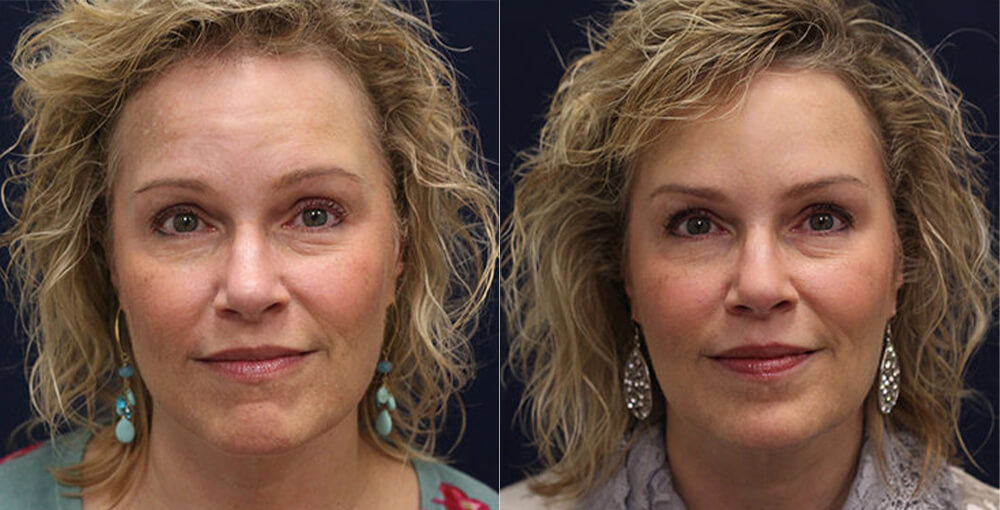 Botox Before and After Photo by Rejuvalife Vitality Institute in Los Angeles