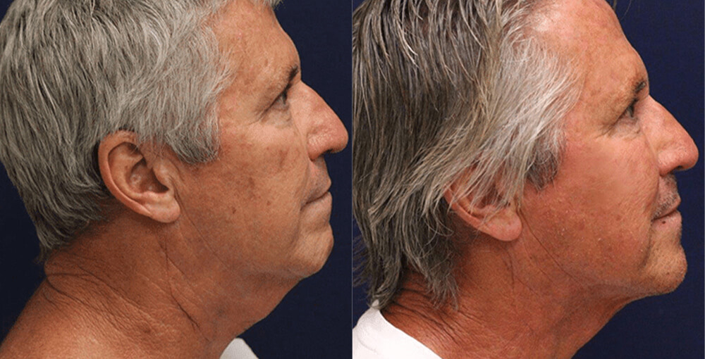 Non Surgical Rejuvenation Before and After Photo by Rejuvalife Vitality Institute in Los Angeles