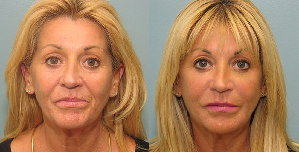 Non Surgical Rejuvenation Before and After Photo by Rejuvalife Vitality Institute in Beverly Hills