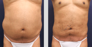 Liposuction for a Beach-Ready Body