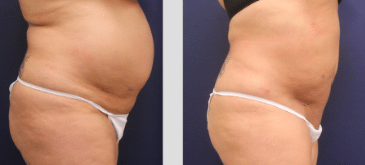 Los Angeles Liposuction Before and After Photos