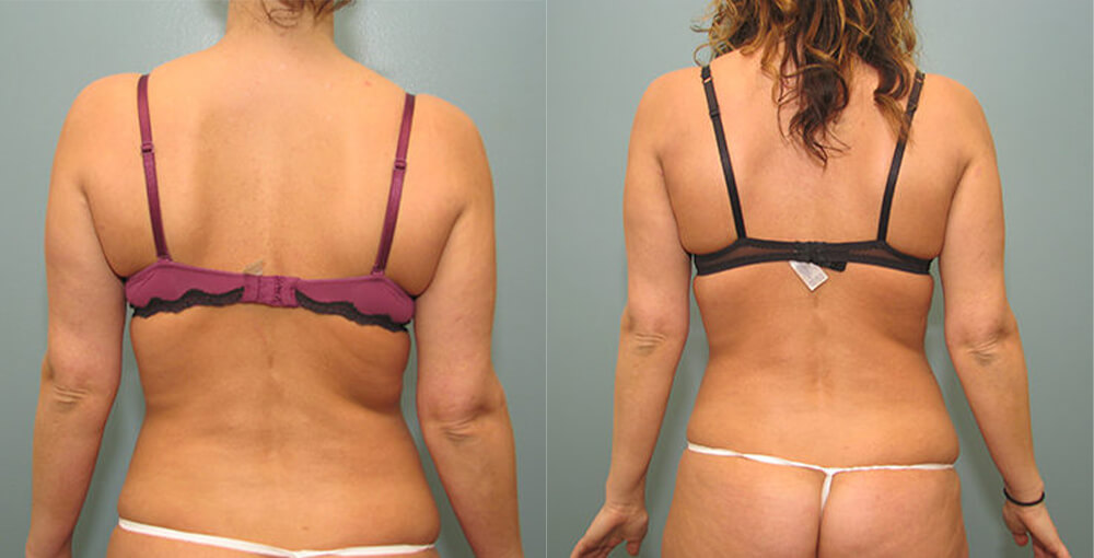 Body Sculpting Los Angeles  Body Contouring Beverly Hills