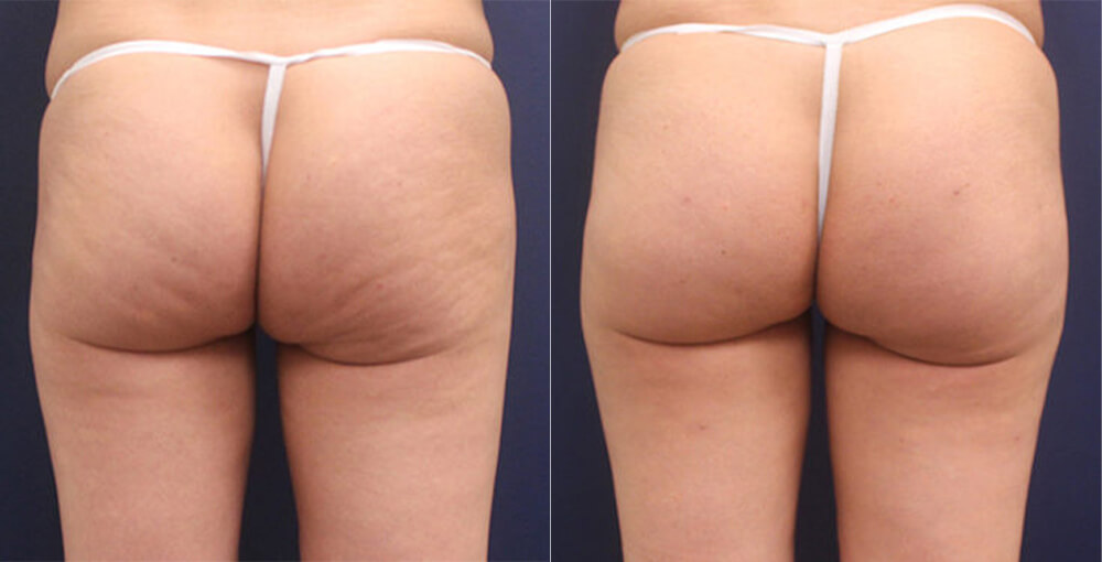 Liposuction Beverly Hills CA - Body Contouring Treatments