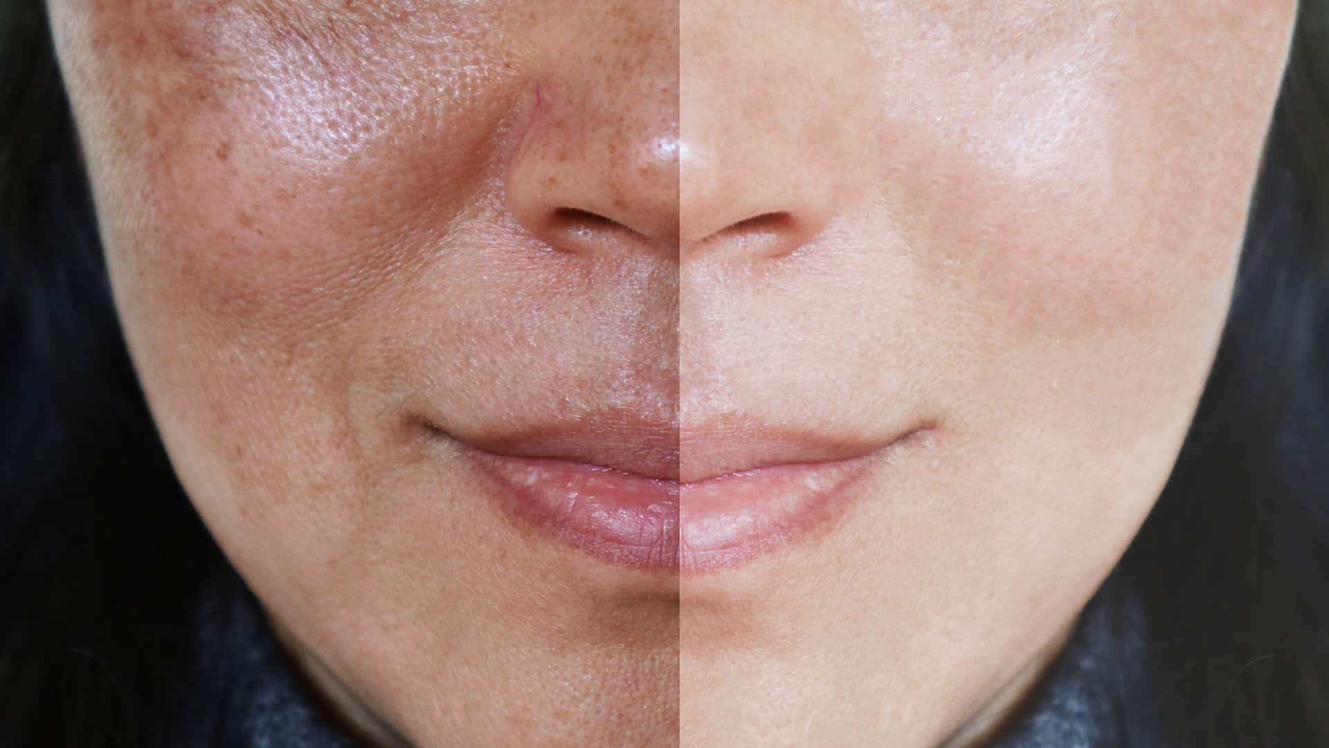 Chemical Peels Before and After Photo by Rejuvalife Vitality Institute in Los Angeles