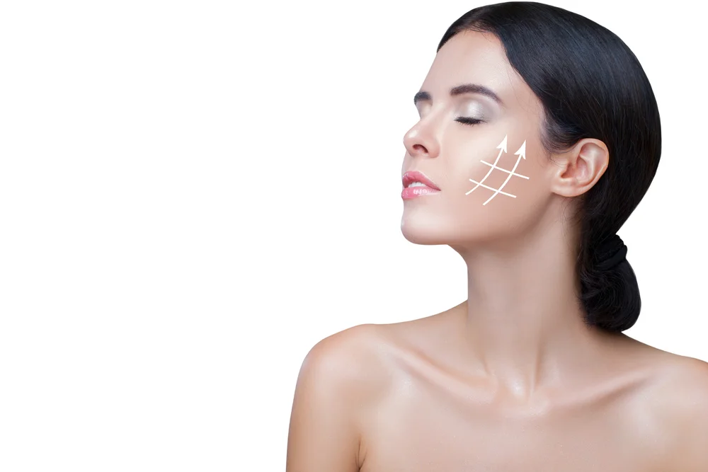 Close-up side view of a woman's face, showcasing immediate mid-face lifting from a minimally invasive thread lift treatment.