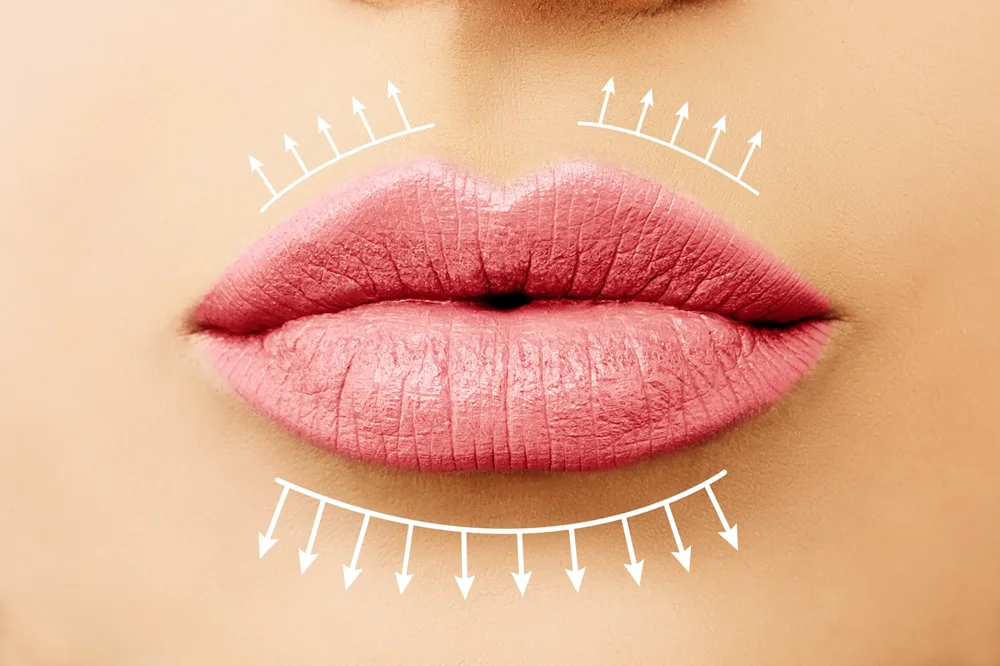 Lip Augmentation for Fuller Lips